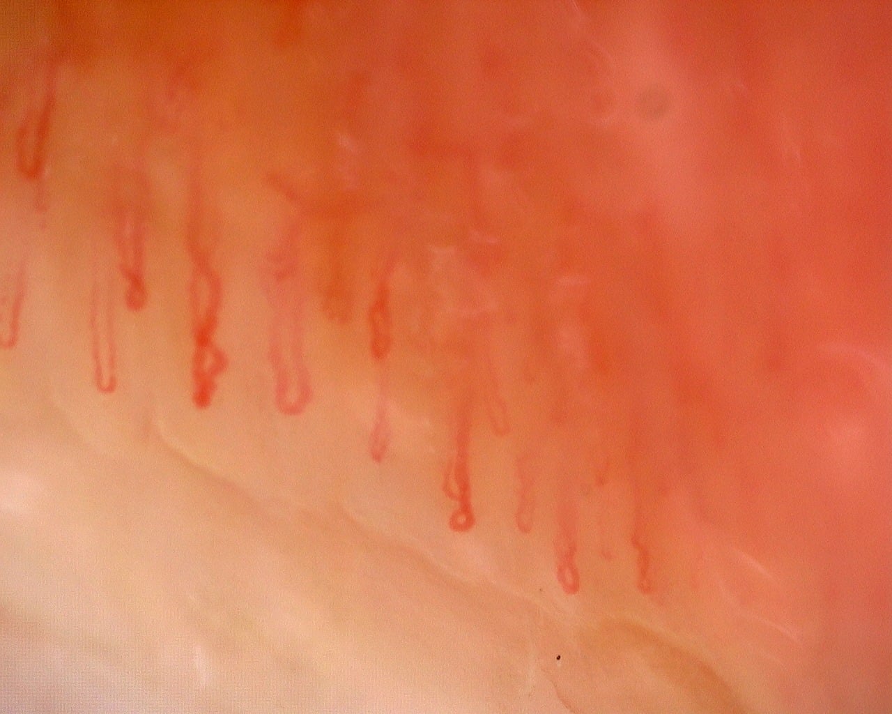 Nailfold capillaroscopy: left middle finger, field a. Juvenile Dermatomyositis with Gottron Lesions and a Scleroderma-Like Pattern.