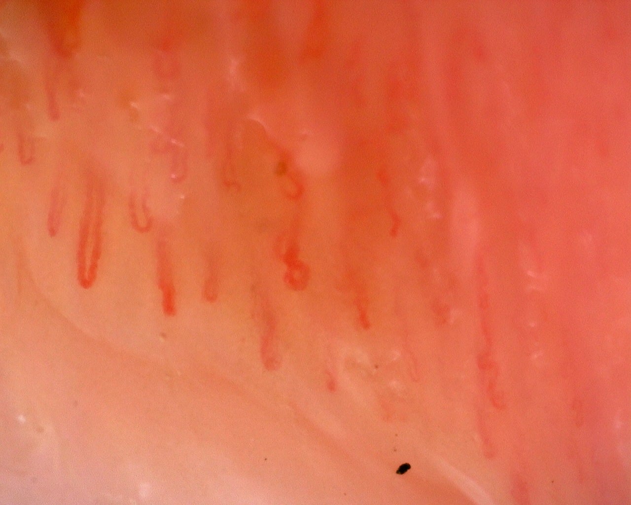Nailfold capillaroscopy: left index finger, field a. Juvenile Dermatomyositis with Gottron Lesions and a Scleroderma-Like Pattern.