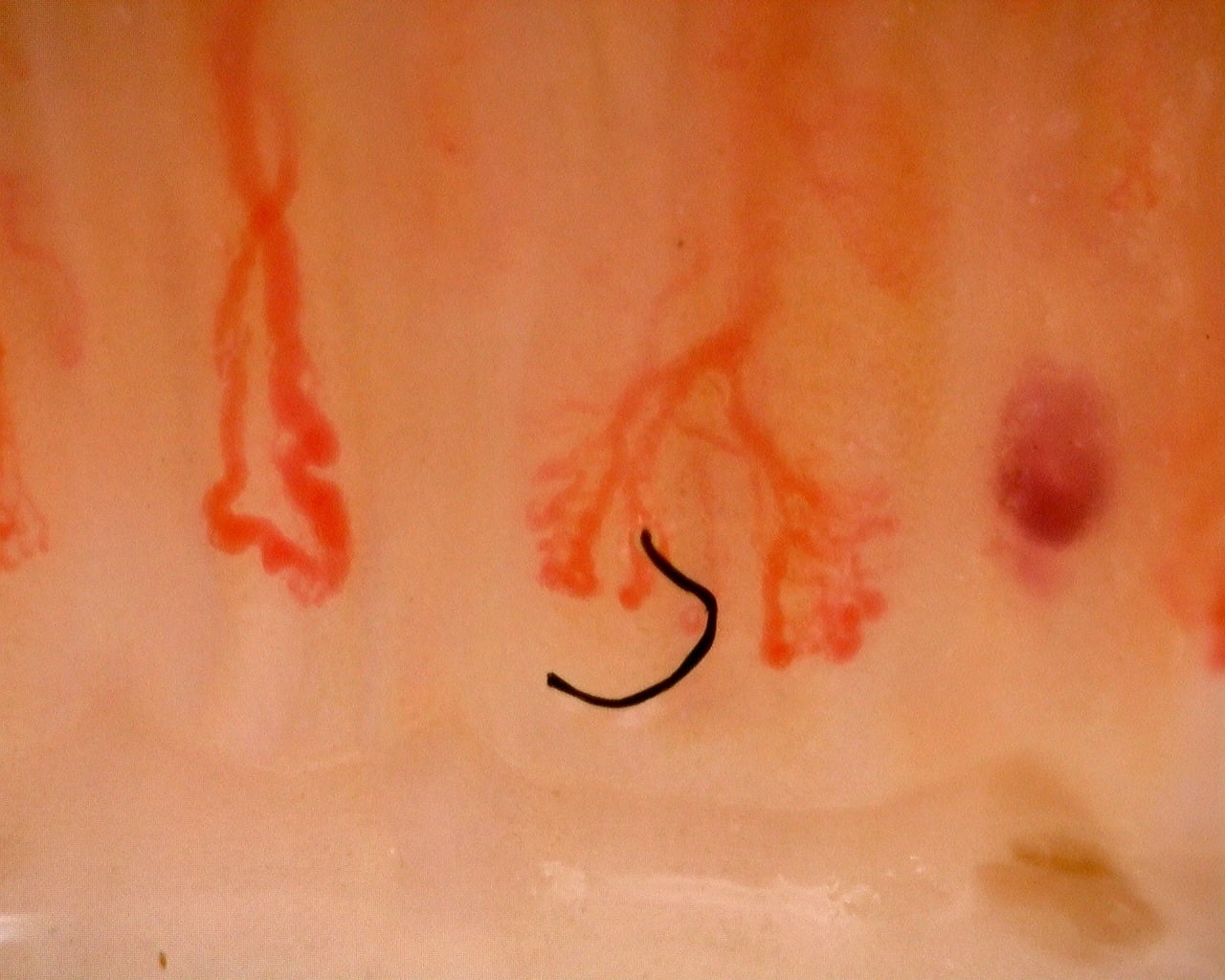 Nailfold capillaroscopy: right little finger, field b. Juvenile Dermatomyositis with Gottron Lesions and a Scleroderma-Like Pattern.