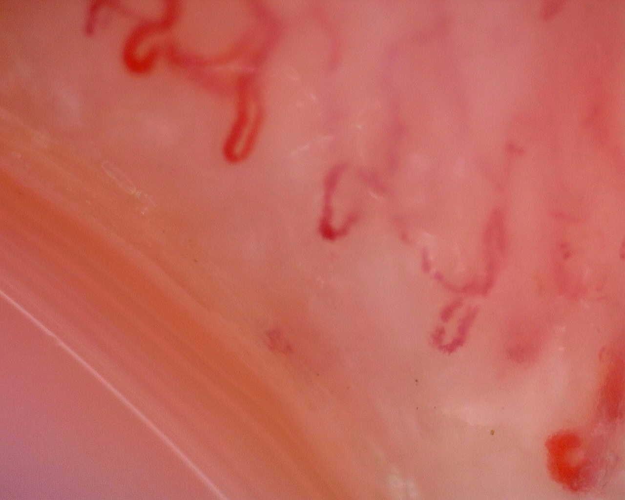 Nailfold capillaroscopy: left ring finger, field a. Juvenile Dermatomyositis anti-TIF1 with Active Scleroderma-Like Pattern.