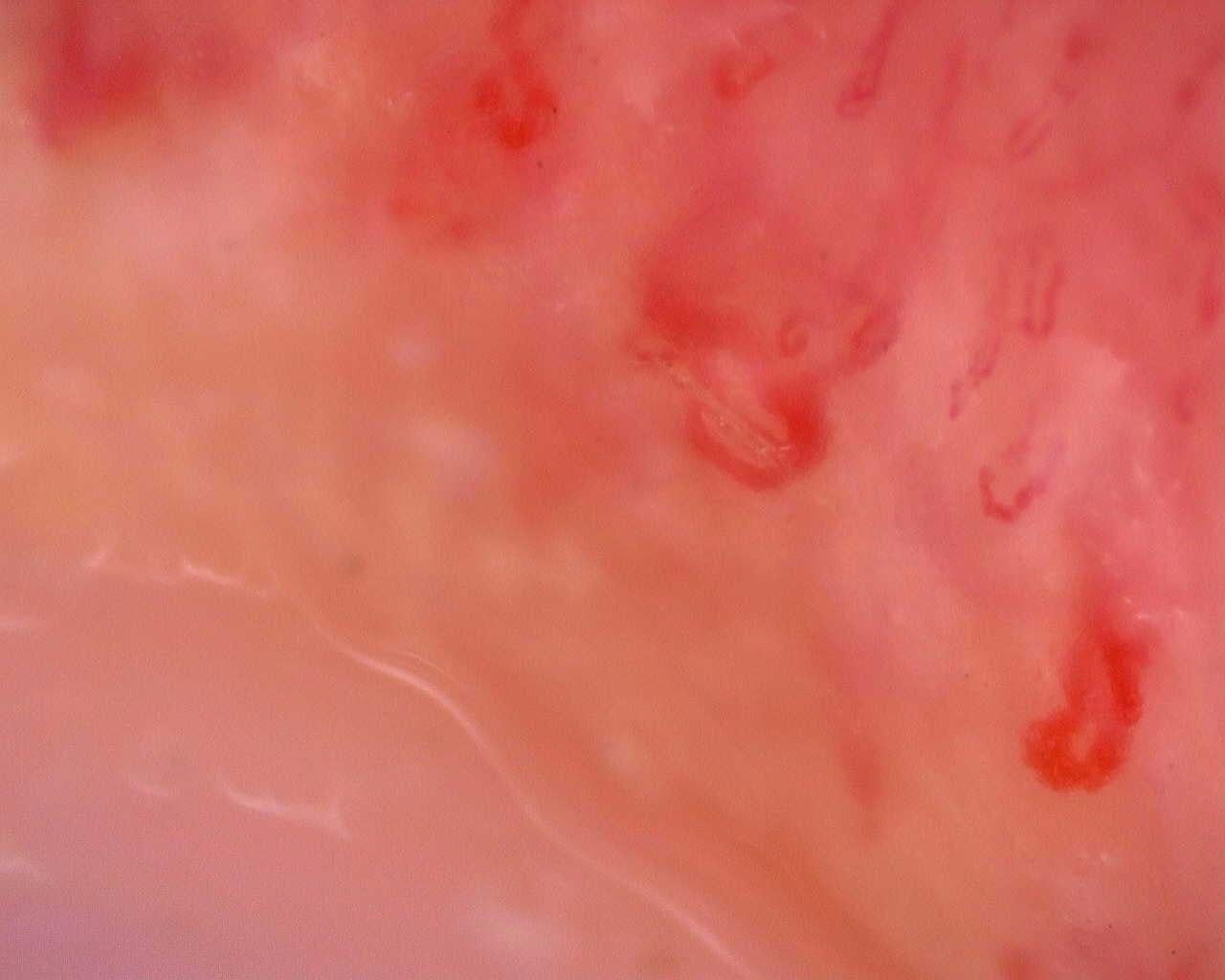 Nailfold capillaroscopy: right index finger, field a. Juvenile Dermatomyositis anti-TIF1 with Active Scleroderma-Like Pattern.