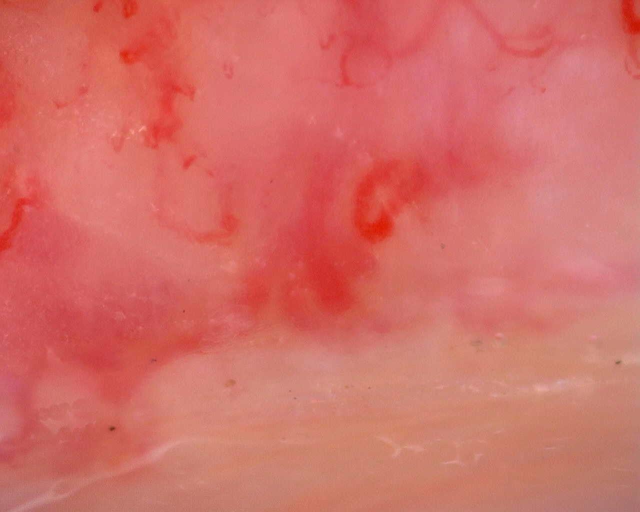 Nailfold capillaroscopy: right ring finger, field a. Juvenile Dermatomyositis anti-TIF1 with Active Scleroderma-Like Pattern.