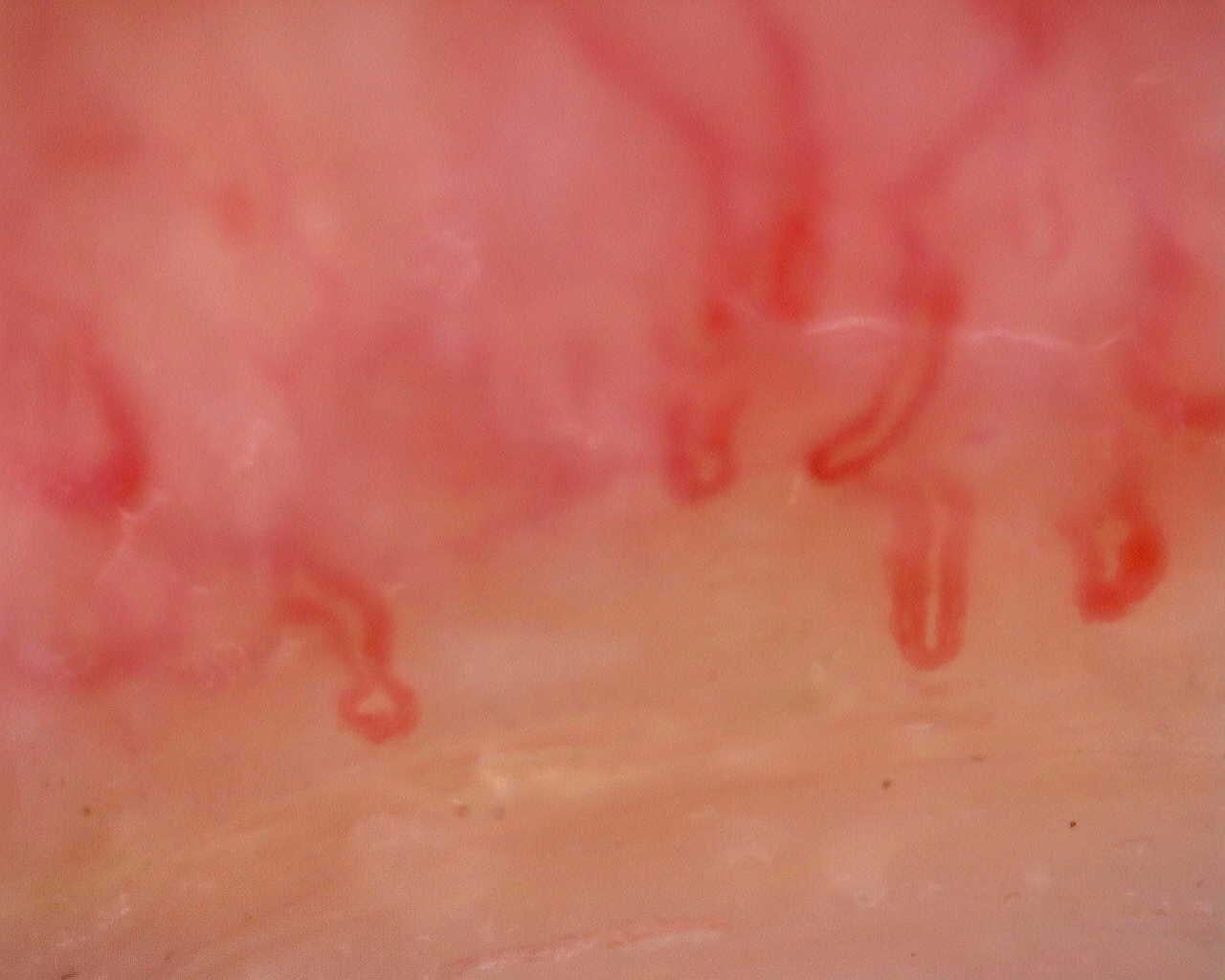 Nailfold capillaroscopy: right middle finger, field a. Juvenile Dermatomyositis anti-TIF1 with Active Scleroderma-Like Pattern.