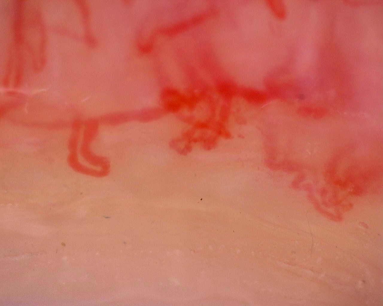 Nailfold capillaroscopy: right middle finger, field a. Juvenile Dermatomyositis anti-TIF1 with Active Scleroderma-Like Pattern.