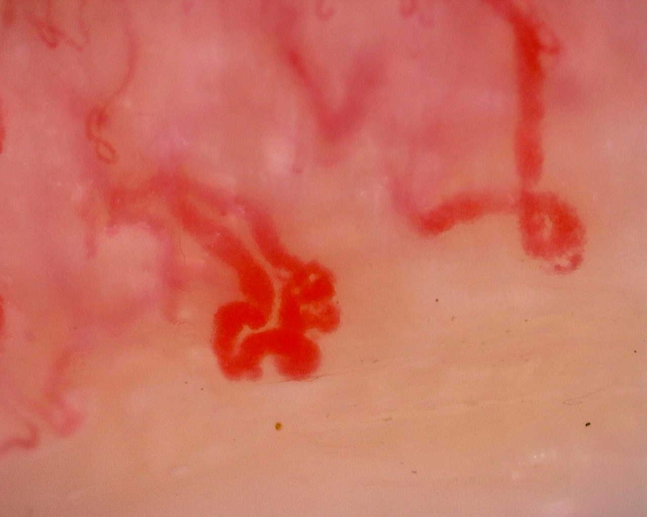 Nailfold capillaroscopy: right index finger, field a. Juvenile Dermatomyositis anti-TIF1 with Active Scleroderma-Like Pattern.