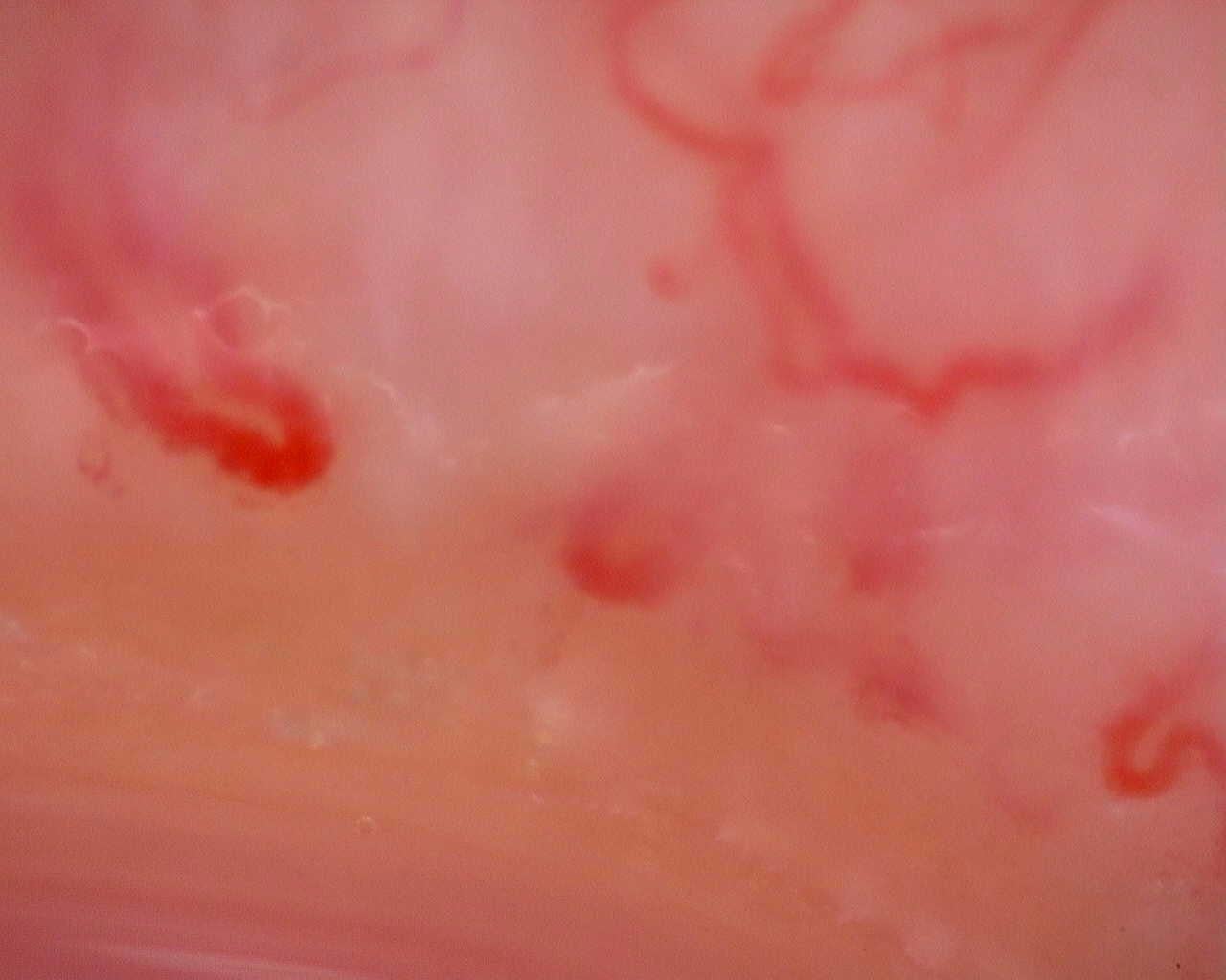 Nailfold capillaroscopy: right little finger, field a. Juvenile Dermatomyositis anti-TIF1 with Active Scleroderma-Like Pattern.