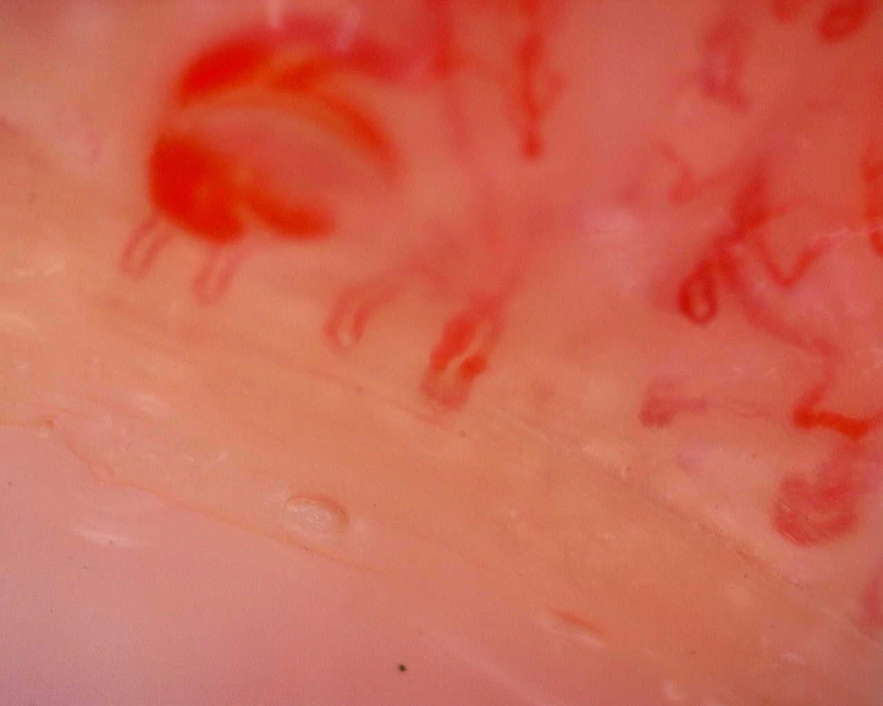 Nailfold capillaroscopy: left index finger, field a. Juvenile Dermatomyositis anti-TIF1 with Active Scleroderma-Like Pattern.