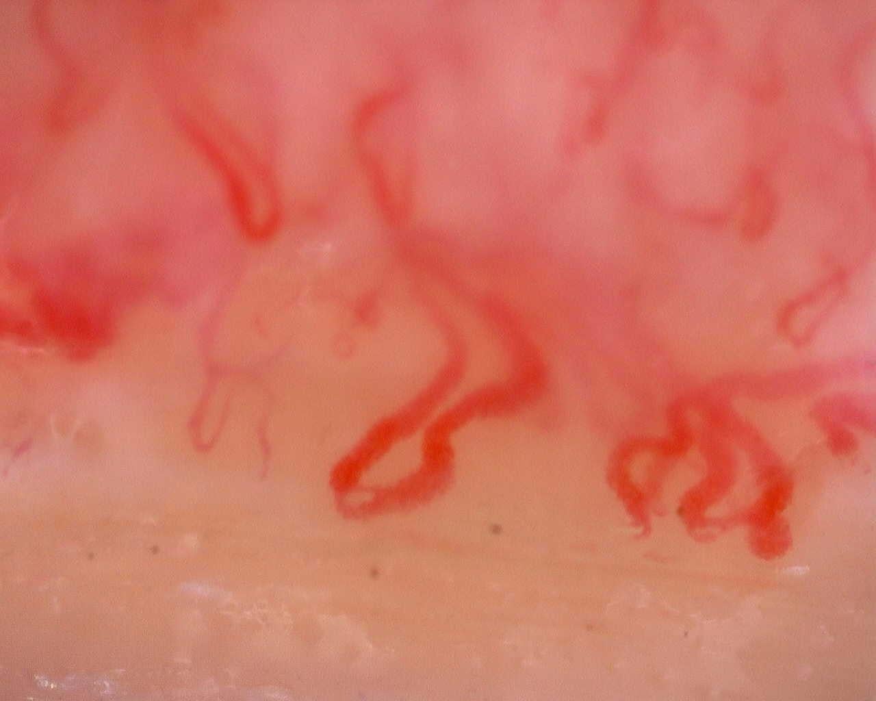 Nailfold capillaroscopy: left middle finger, field a. Juvenile Dermatomyositis anti-TIF1 with Active Scleroderma-Like Pattern.