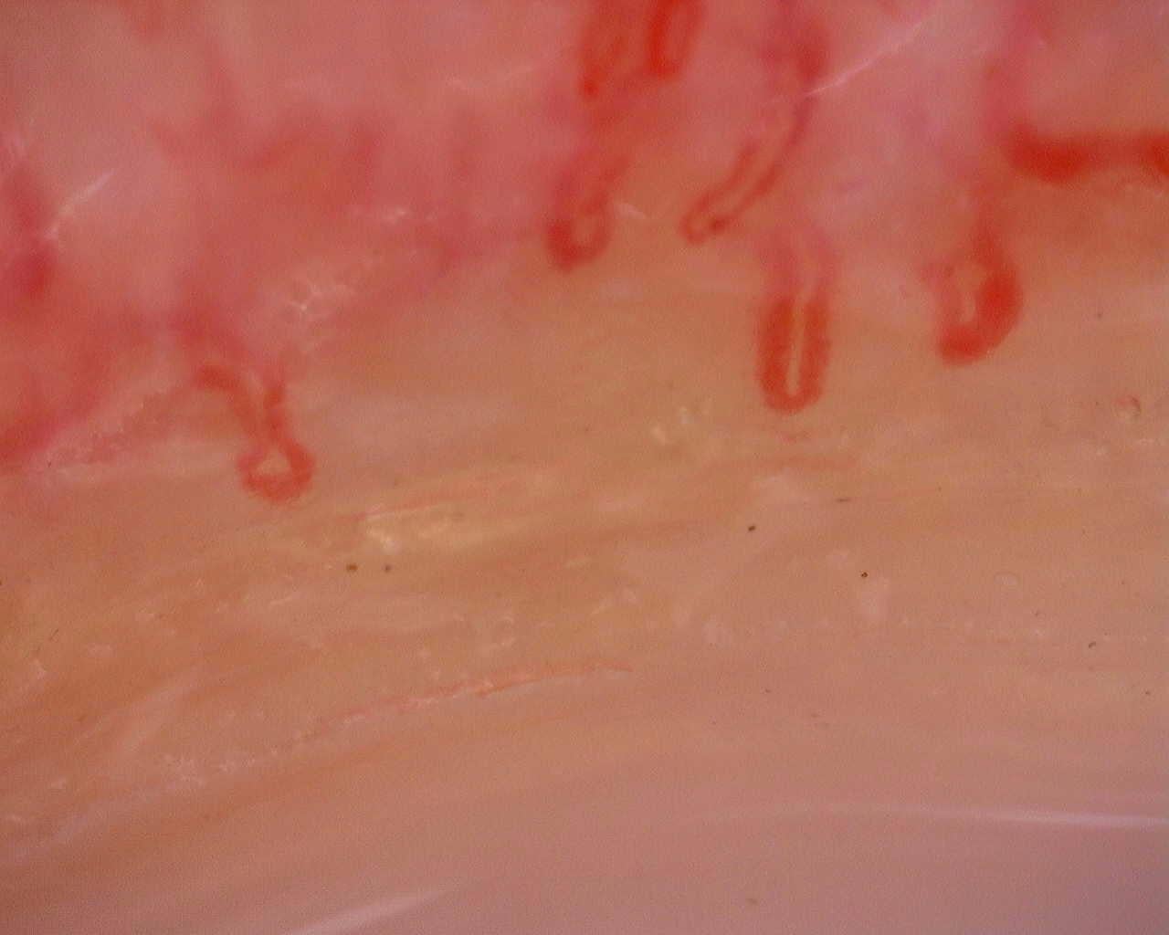 Nailfold capillaroscopy: right middle finger, field a. Juvenile Dermatomyositis anti-TIF1 with Active Scleroderma-Like Pattern.