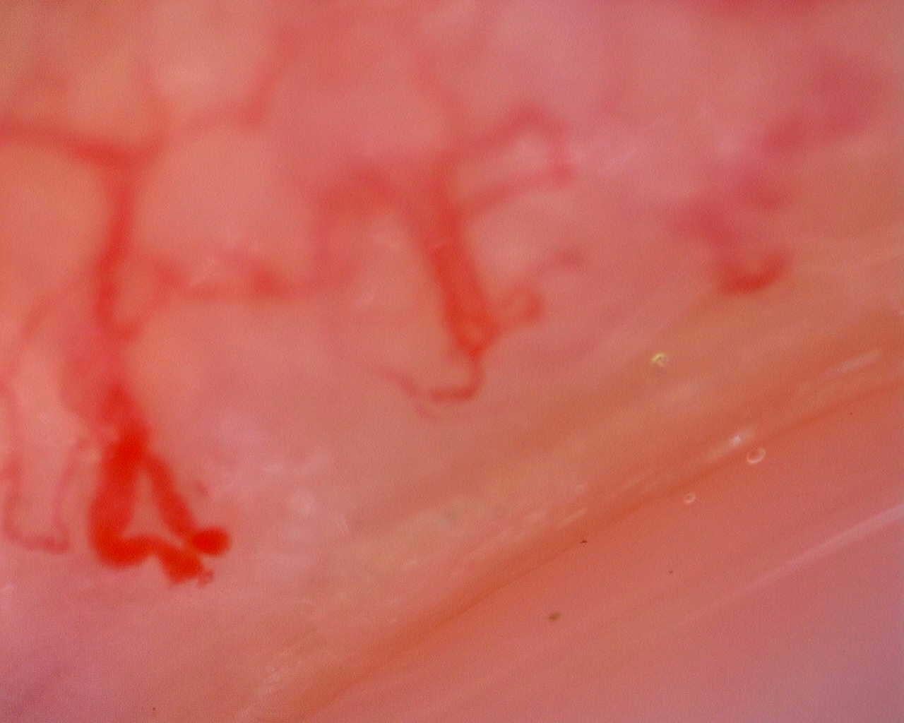 Nailfold capillaroscopy: left ring finger, field a. Juvenile Dermatomyositis anti-TIF1 with Active Scleroderma-Like Pattern.