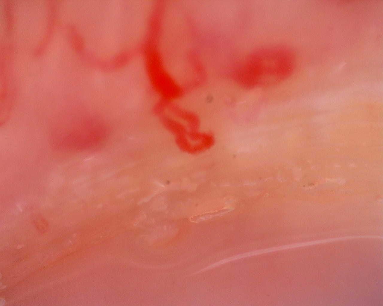 Nailfold capillaroscopy: left middle finger, field a. Juvenile Dermatomyositis anti-TIF1 with Active Scleroderma-Like Pattern.
