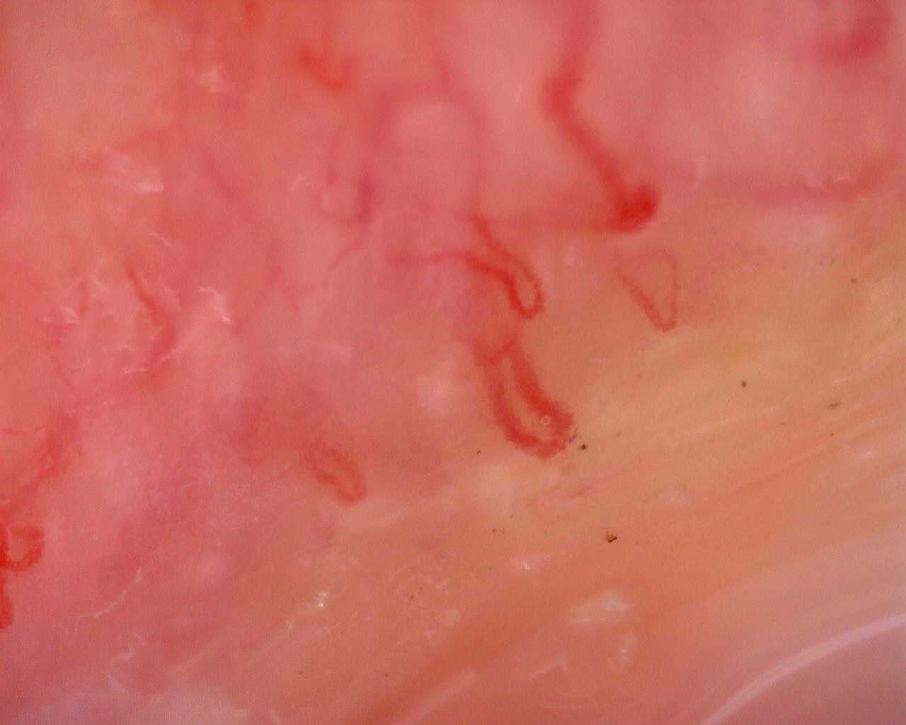 Nailfold capillaroscopy: right middle finger, field a. Juvenile Dermatomyositis anti-TIF1 with Active Scleroderma-Like Pattern.