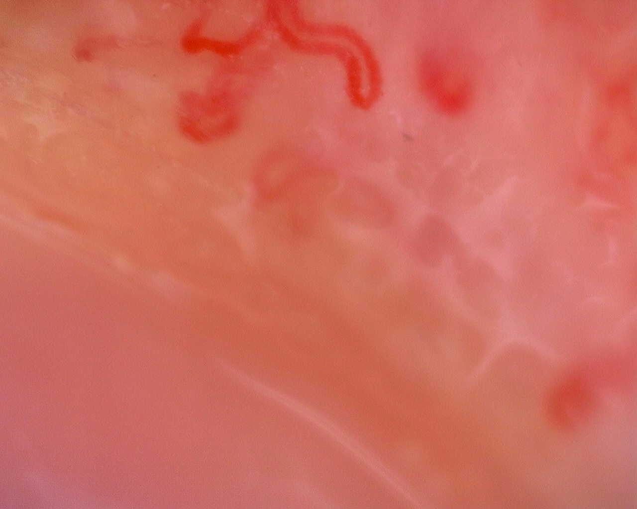 Nailfold capillaroscopy: left index finger, field a. Juvenile Dermatomyositis anti-TIF1 with Active Scleroderma-Like Pattern.