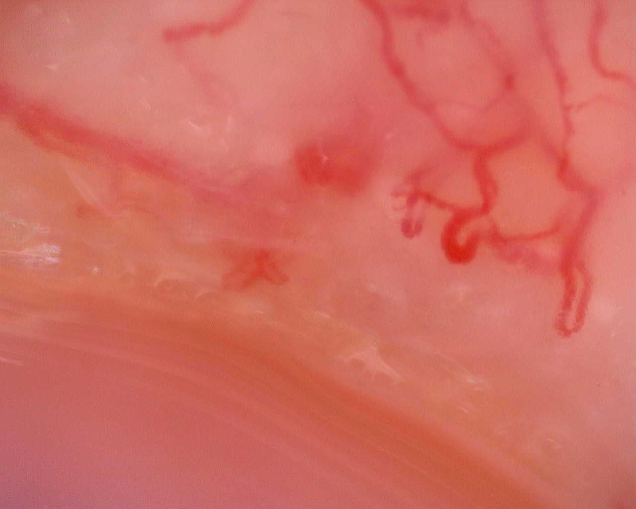 Nailfold capillaroscopy: left middle finger, field a. Juvenile Dermatomyositis anti-TIF1 with Active Scleroderma-Like Pattern.
