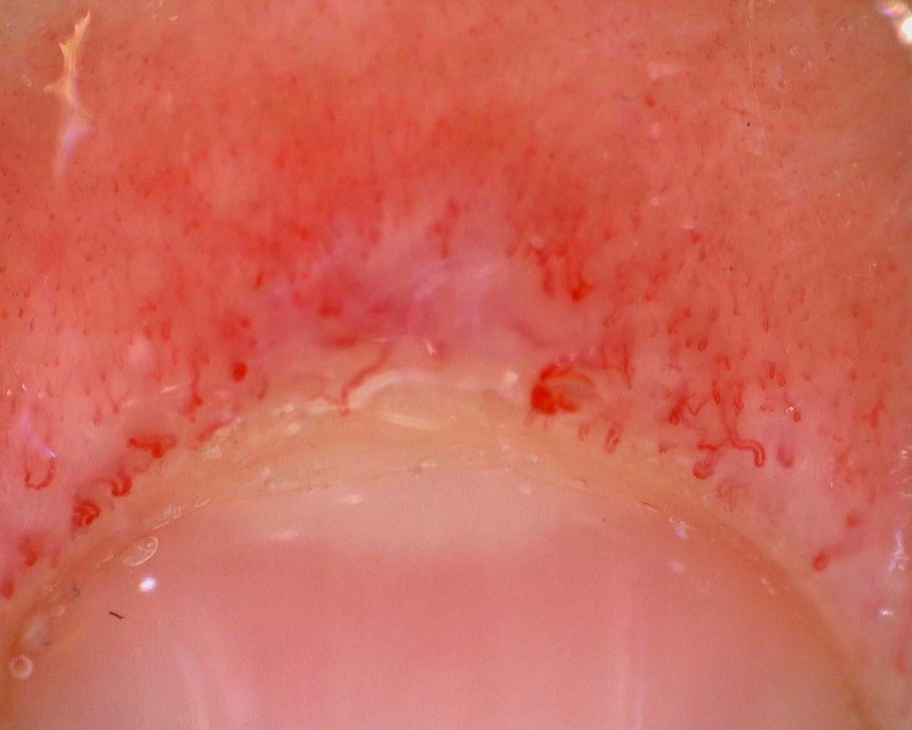 Overview from the active juvenile anti-TIF1 dermatomyositis case. Open the source study to examine the arborizing capillaries described in its report.