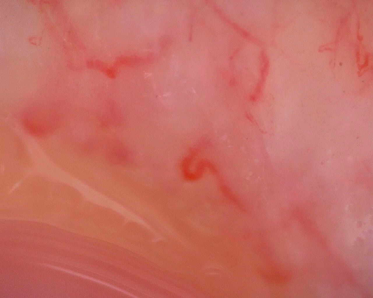 Nailfold capillaroscopy: right little finger, field a. Juvenile Dermatomyositis anti-TIF1 with Active Scleroderma-Like Pattern.