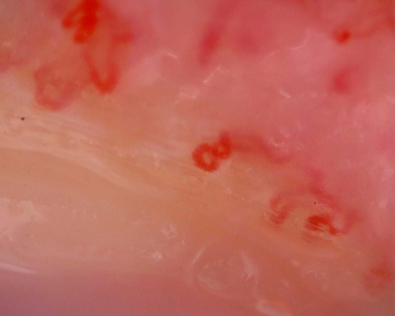 Nailfold capillaroscopy: left middle finger, field a. Juvenile Dermatomyositis anti-TIF1 with Active Scleroderma-Like Pattern.