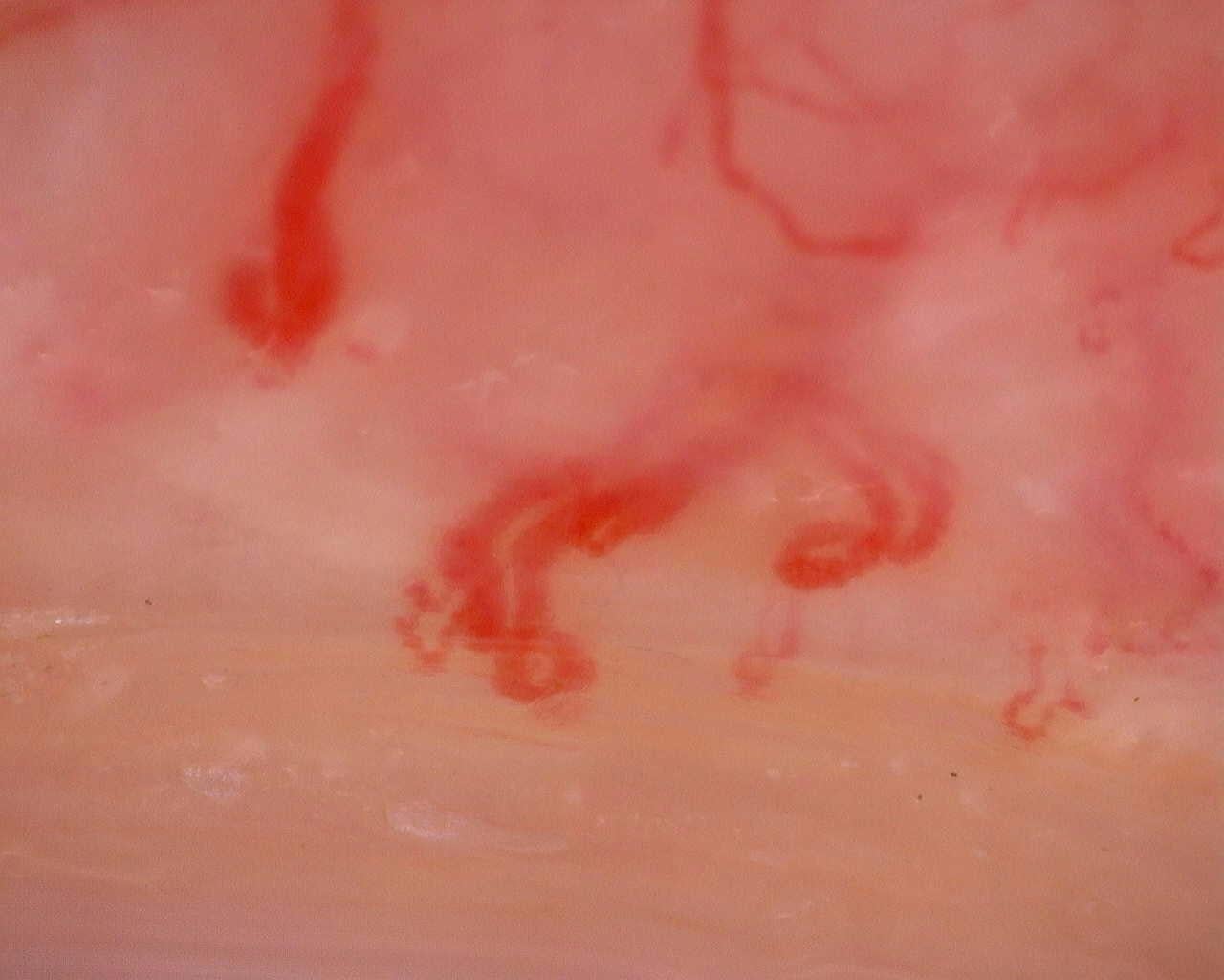 Nailfold capillaroscopy: right ring finger, field a. Juvenile Dermatomyositis anti-TIF1 with Active Scleroderma-Like Pattern.