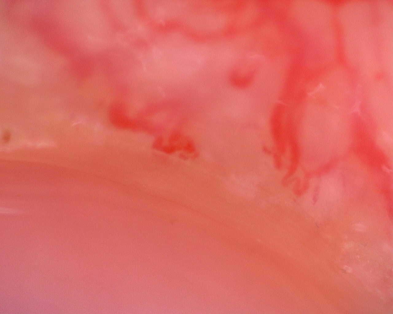 Nailfold capillaroscopy: left little finger, field a. Juvenile Dermatomyositis anti-TIF1 with Active Scleroderma-Like Pattern.