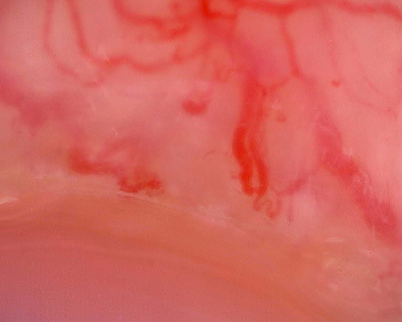 Nailfold capillaroscopy: left little finger, field a. Juvenile Dermatomyositis anti-TIF1 with Active Scleroderma-Like Pattern.