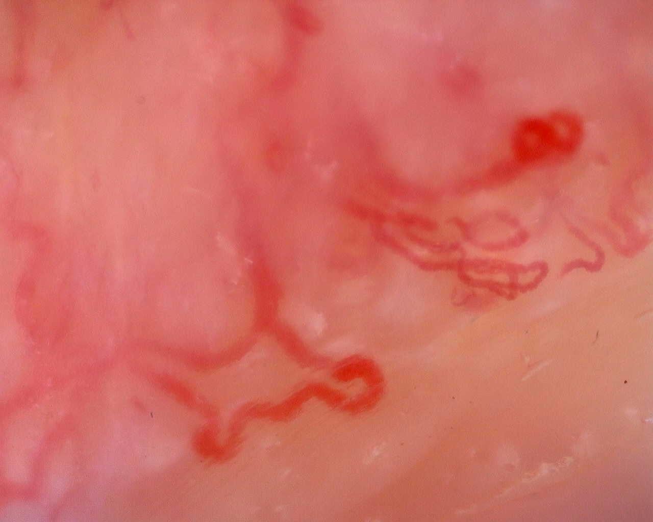 Nailfold capillaroscopy: right index finger, field a. Juvenile Dermatomyositis anti-TIF1 with Active Scleroderma-Like Pattern.