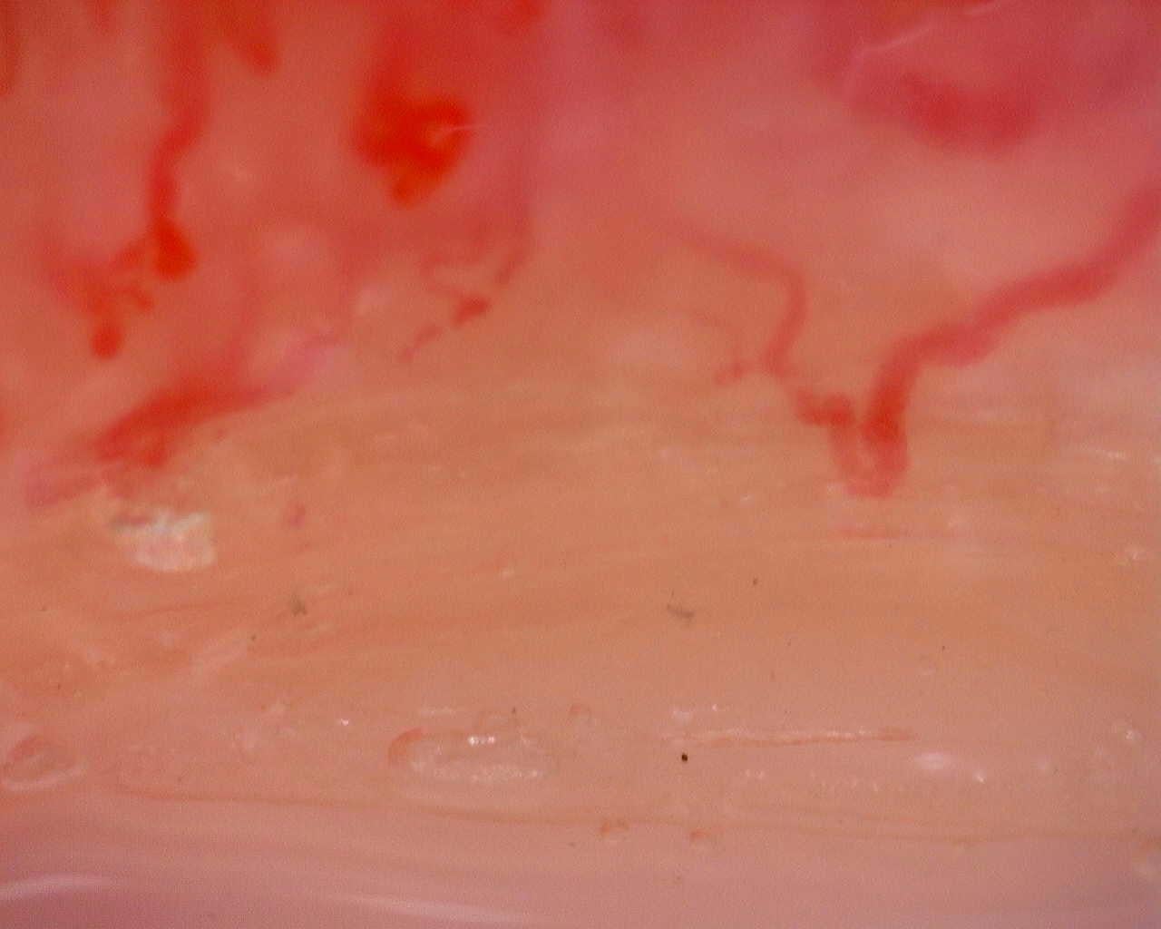 Nailfold capillaroscopy: left index finger, field a. Juvenile Dermatomyositis anti-TIF1 with Active Scleroderma-Like Pattern.