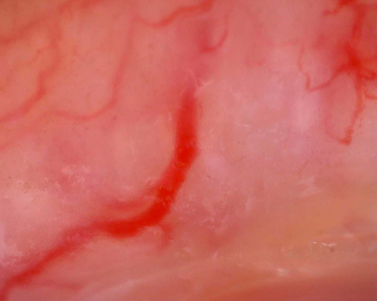 Nailfold capillaroscopy: left little finger, field a. Juvenile Dermatomyositis anti-TIF1 with Active Scleroderma-Like Pattern.
