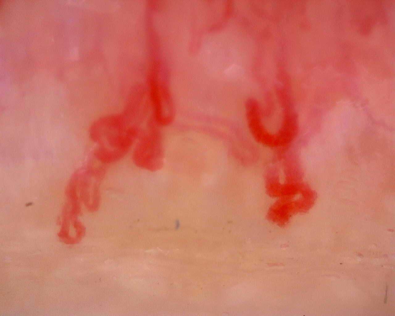 Nailfold capillaroscopy: right index finger, field a. Juvenile Dermatomyositis anti-TIF1 with Active Scleroderma-Like Pattern.