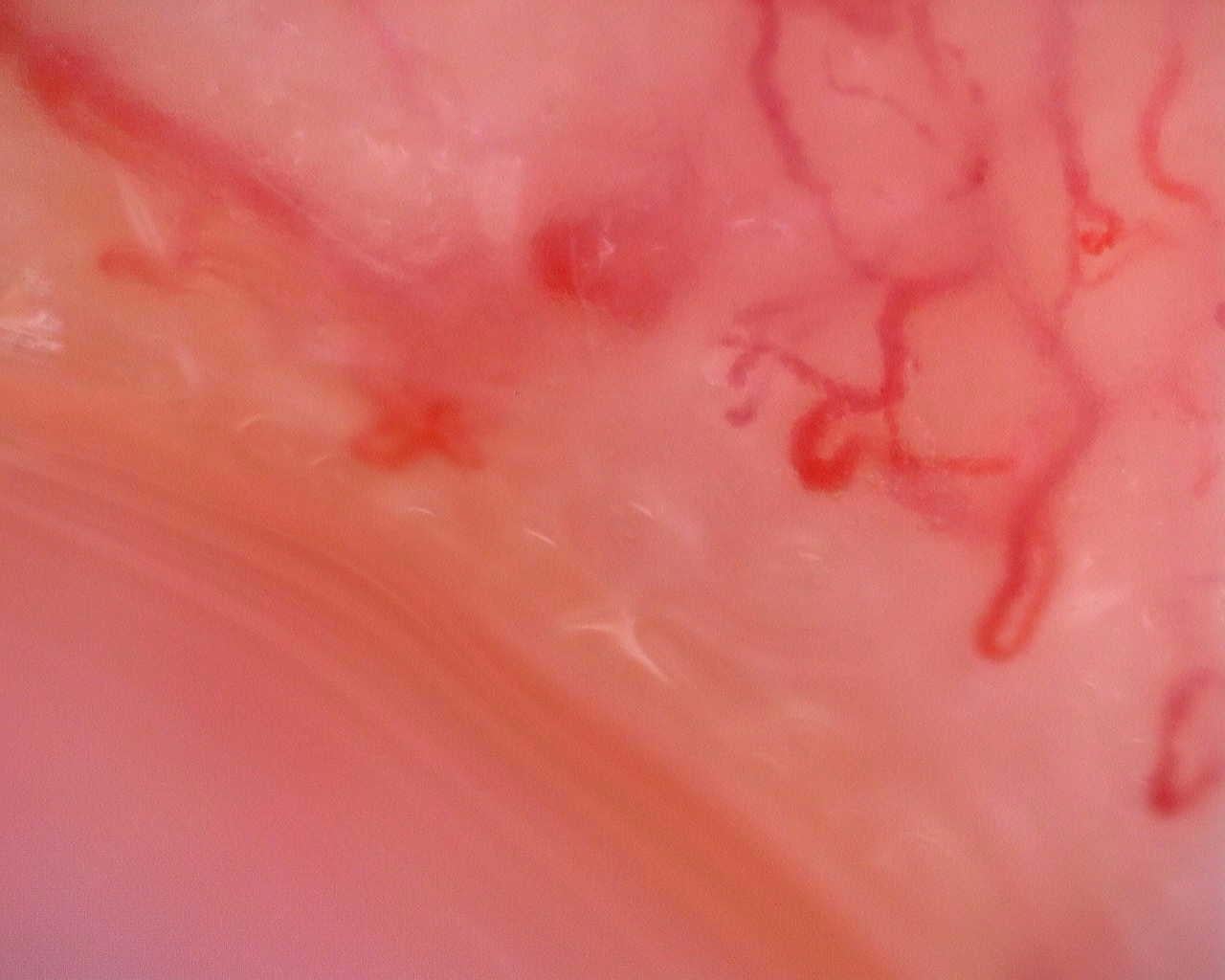 Nailfold capillaroscopy: left ring finger, field a. Juvenile Dermatomyositis anti-TIF1 with Active Scleroderma-Like Pattern.