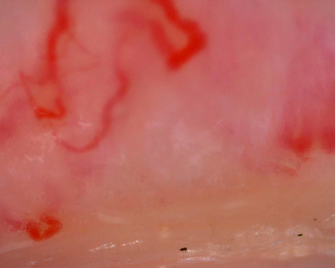 Nailfold capillaroscopy: left ring finger, field a. Juvenile Dermatomyositis anti-TIF1 with Active Scleroderma-Like Pattern.