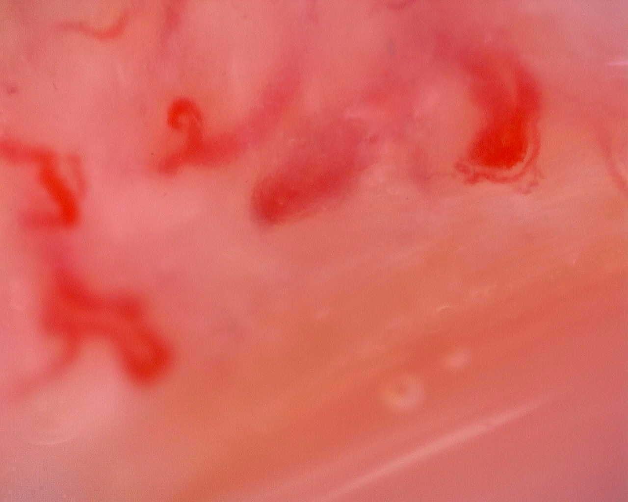 Nailfold capillaroscopy: right little finger, field a. Juvenile Dermatomyositis anti-TIF1 with Active Scleroderma-Like Pattern.