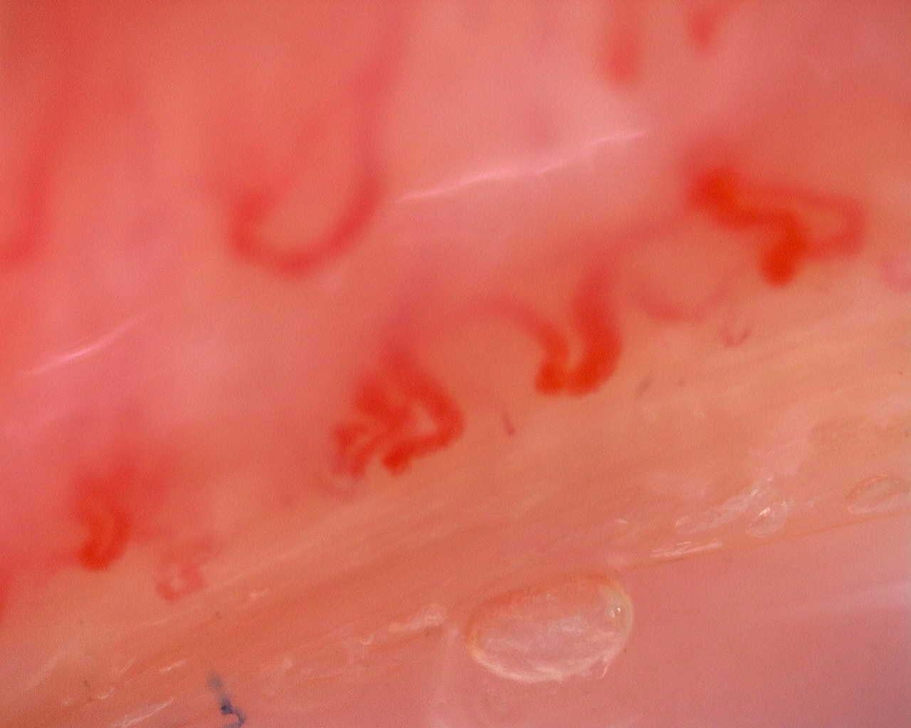 Nailfold capillaroscopy: left index finger, field a. Juvenile Dermatomyositis anti-TIF1 with Active Scleroderma-Like Pattern.