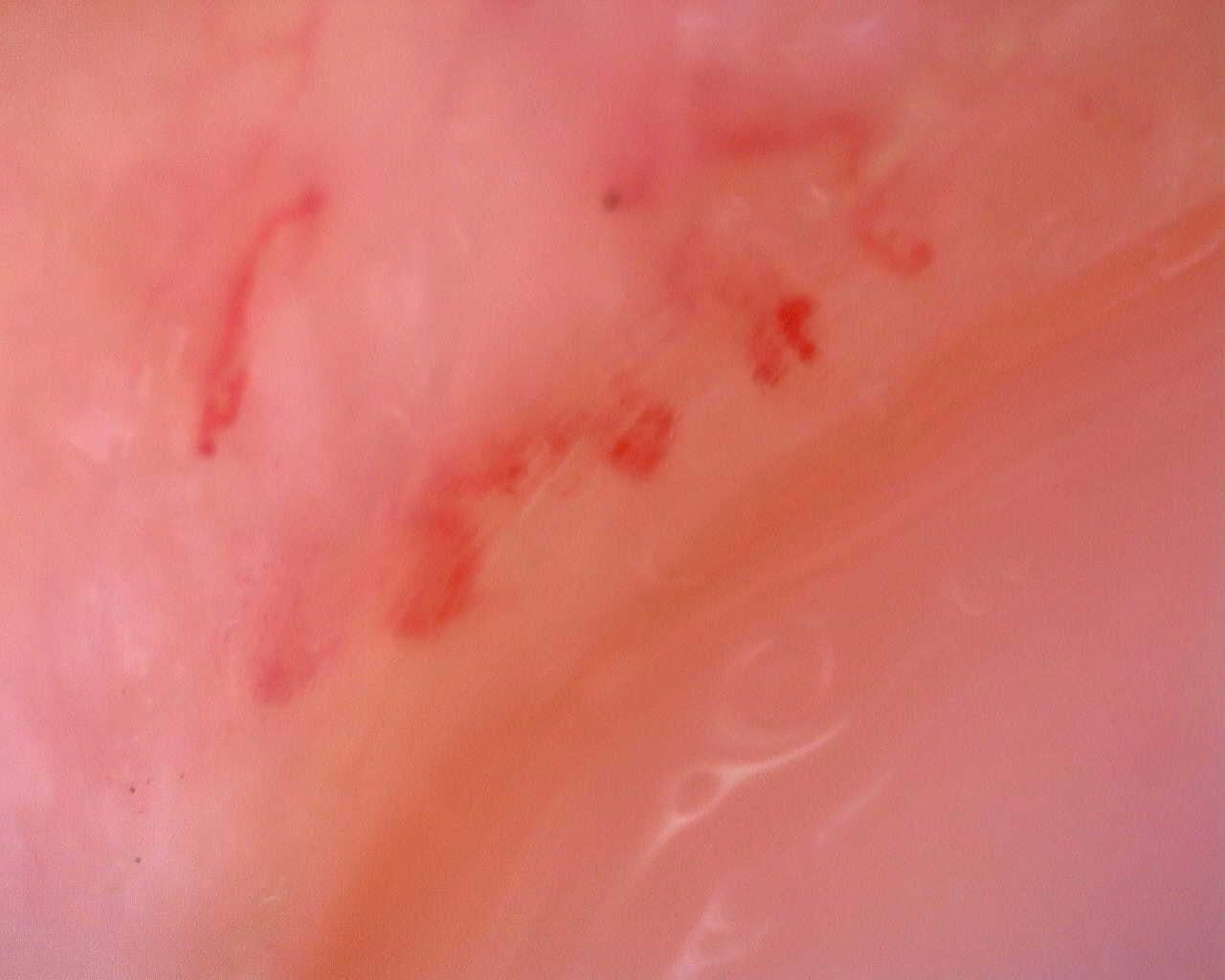 Nailfold capillaroscopy: right ring finger, field a. Juvenile Dermatomyositis anti-TIF1 with Active Scleroderma-Like Pattern.