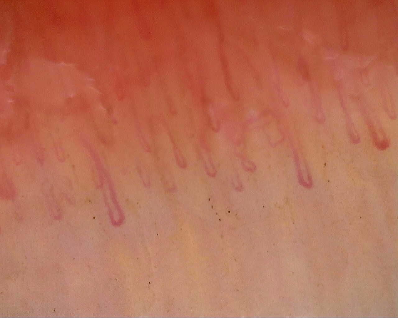 Nailfold capillaroscopy: right ring finger, field a. Follow-up study. Mixed Connective Tissue Disease Presenting with Raynaud Phenomenon.