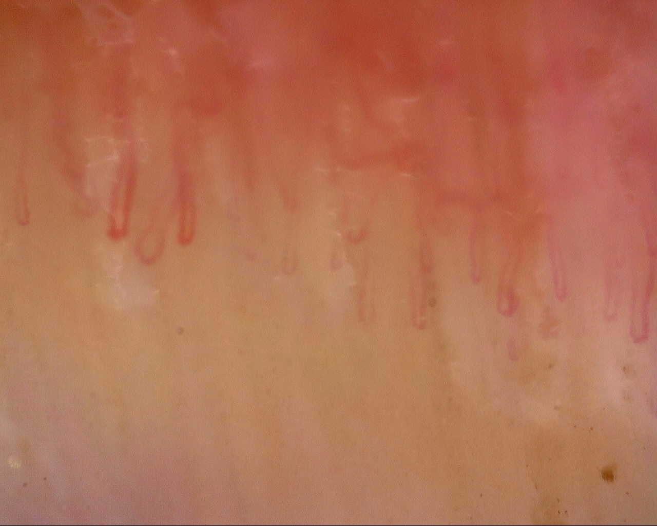 Nailfold capillaroscopy: left ring finger, field a. Follow-up study. Mixed Connective Tissue Disease Presenting with Raynaud Phenomenon.