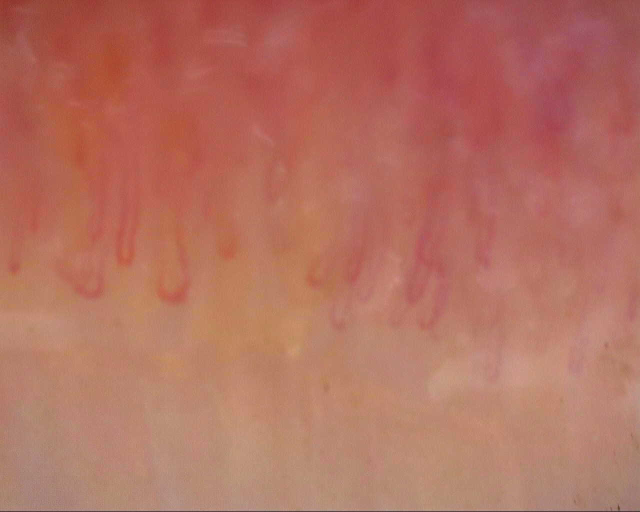 Nailfold capillaroscopy: left index finger, field a. Follow-up study. Mixed Connective Tissue Disease Presenting with Raynaud Phenomenon.
