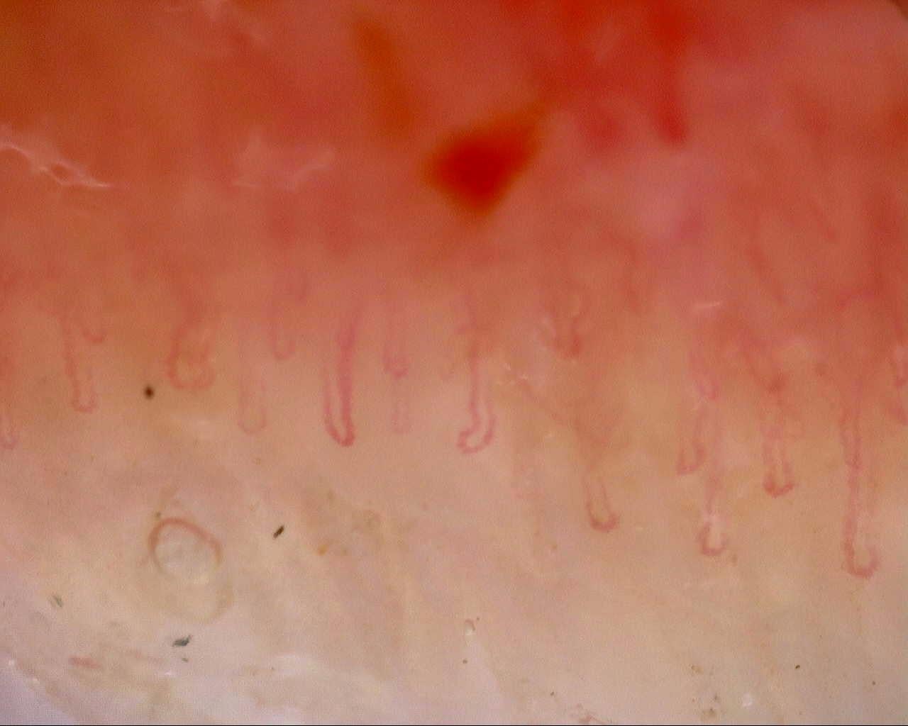 Nailfold capillaroscopy: right little finger, field a. Follow-up study. Mixed Connective Tissue Disease Presenting with Raynaud Phenomenon.