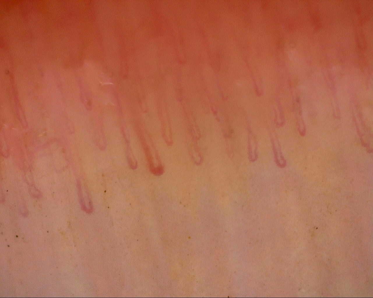 Nailfold capillaroscopy: right ring finger, field a. Follow-up study. Mixed Connective Tissue Disease Presenting with Raynaud Phenomenon.
