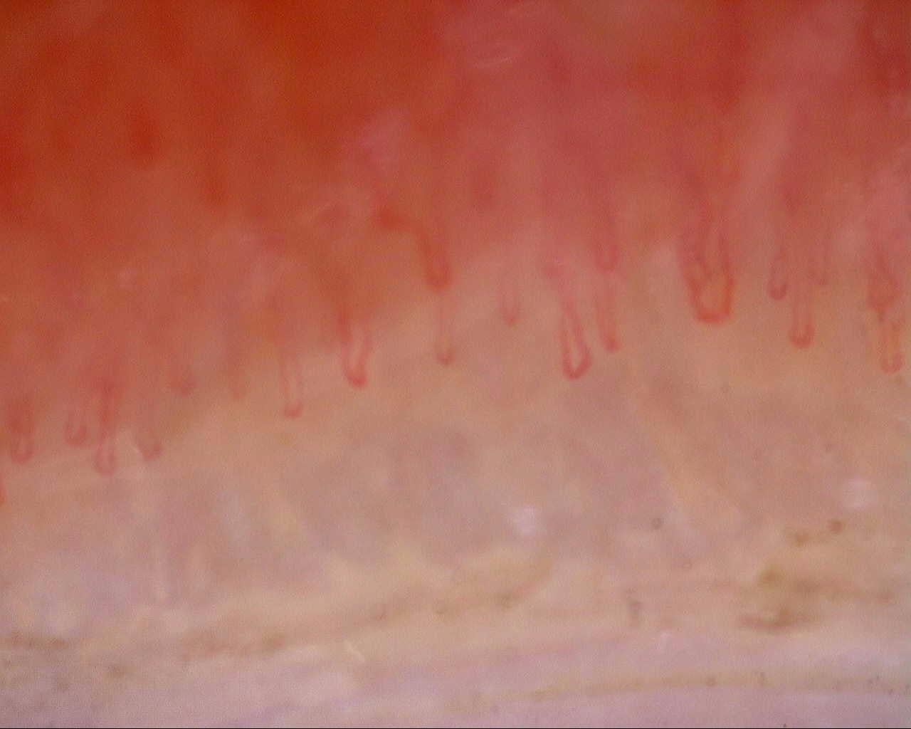 Nailfold capillaroscopy: left little finger, field a. Follow-up study. Mixed Connective Tissue Disease Presenting with Raynaud Phenomenon.
