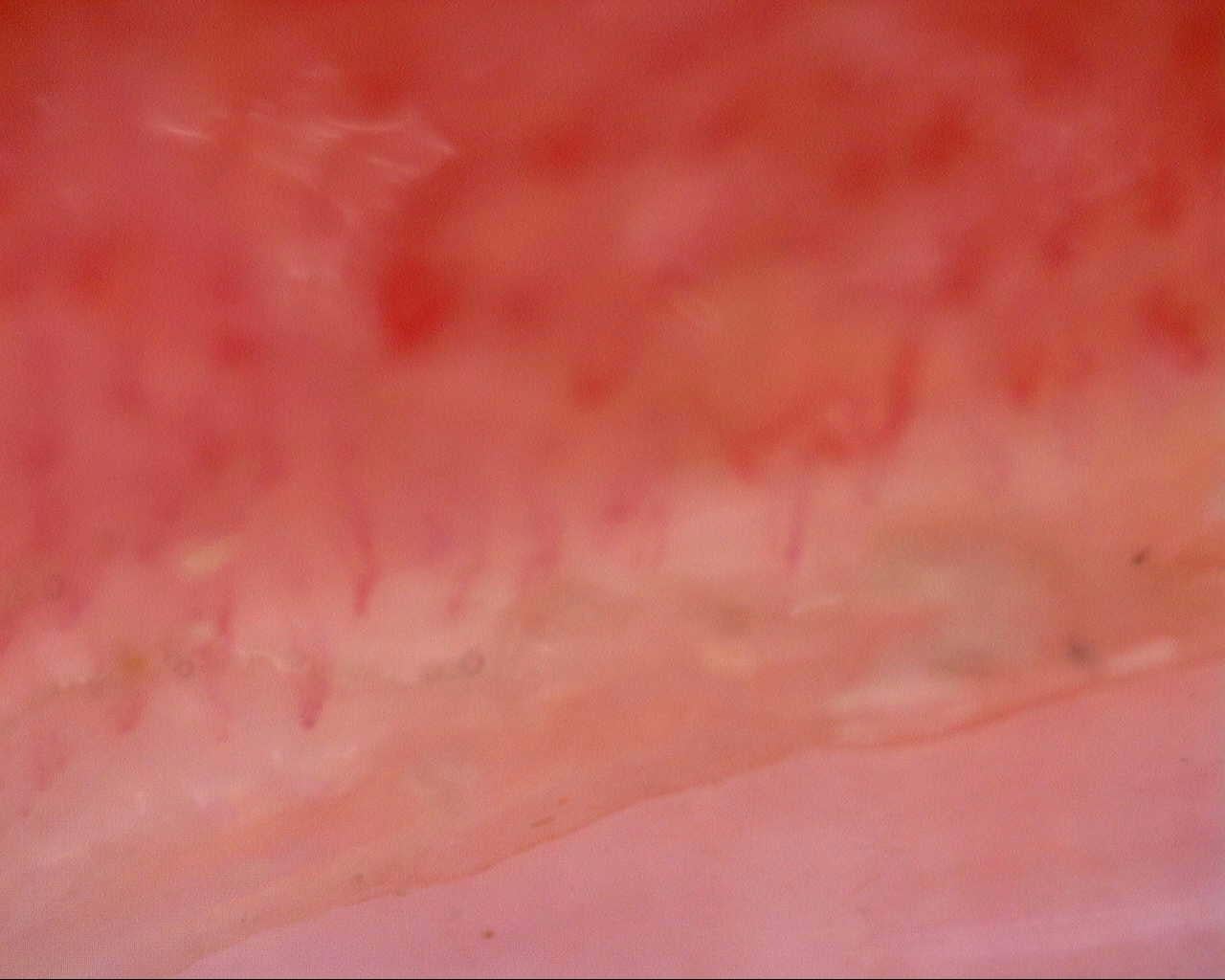 Nailfold capillaroscopy: right little finger, field a. Follow-up study. Mixed Connective Tissue Disease Presenting with Raynaud Phenomenon.