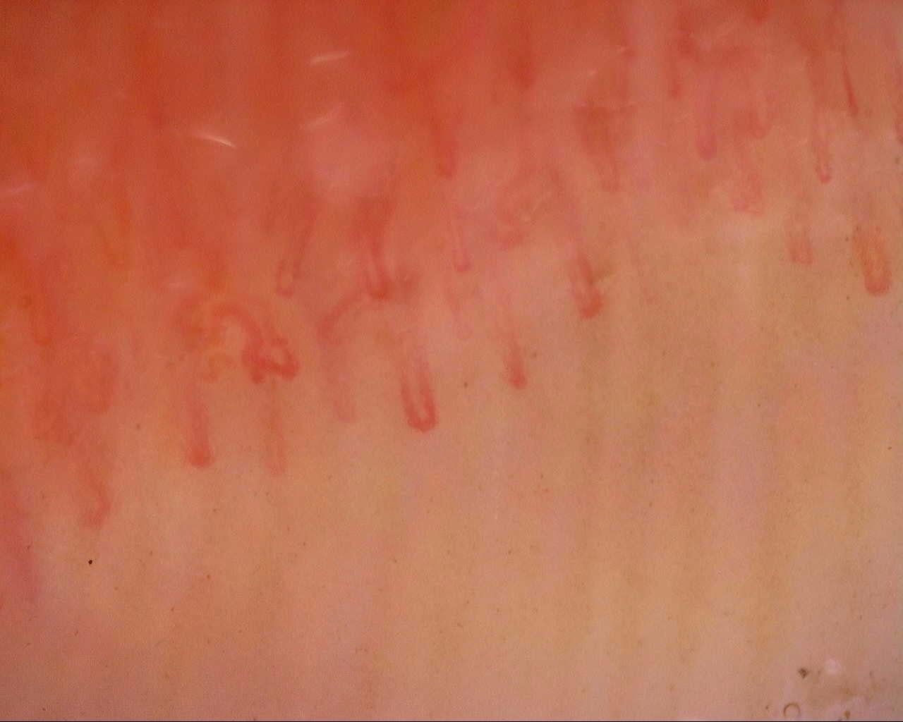 Nailfold capillaroscopy: left ring finger, field a. Follow-up study. Mixed Connective Tissue Disease Presenting with Raynaud Phenomenon.