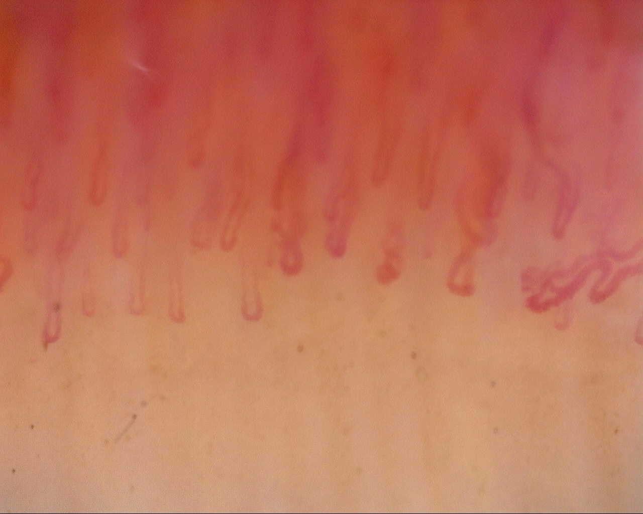 Nailfold capillaroscopy: left index finger, field a. Follow-up study. Mixed Connective Tissue Disease Presenting with Raynaud Phenomenon.