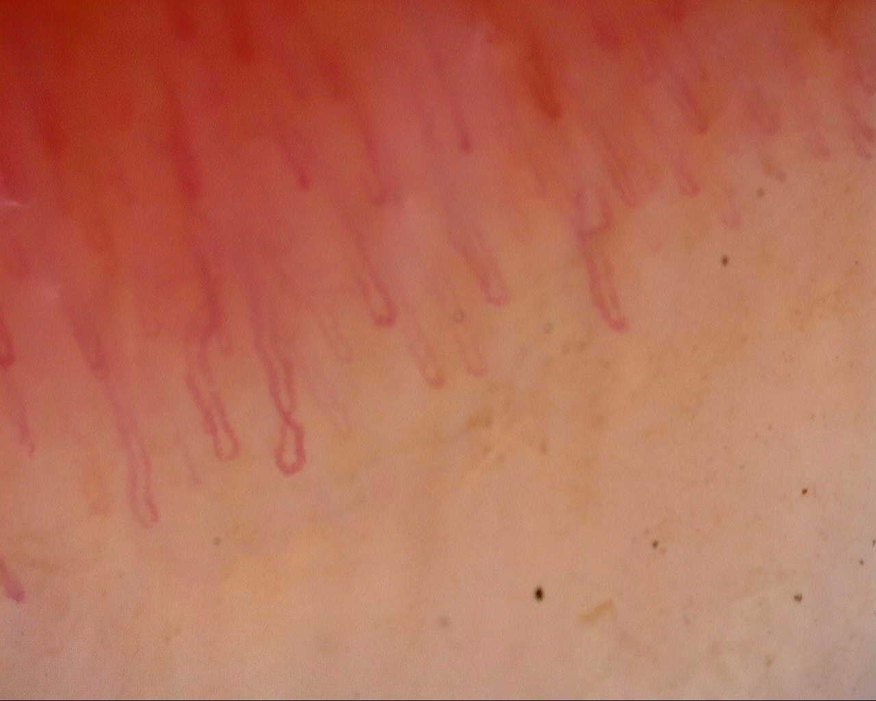 Nailfold capillaroscopy: right index finger, field a. Follow-up study. Mixed Connective Tissue Disease Presenting with Raynaud Phenomenon.