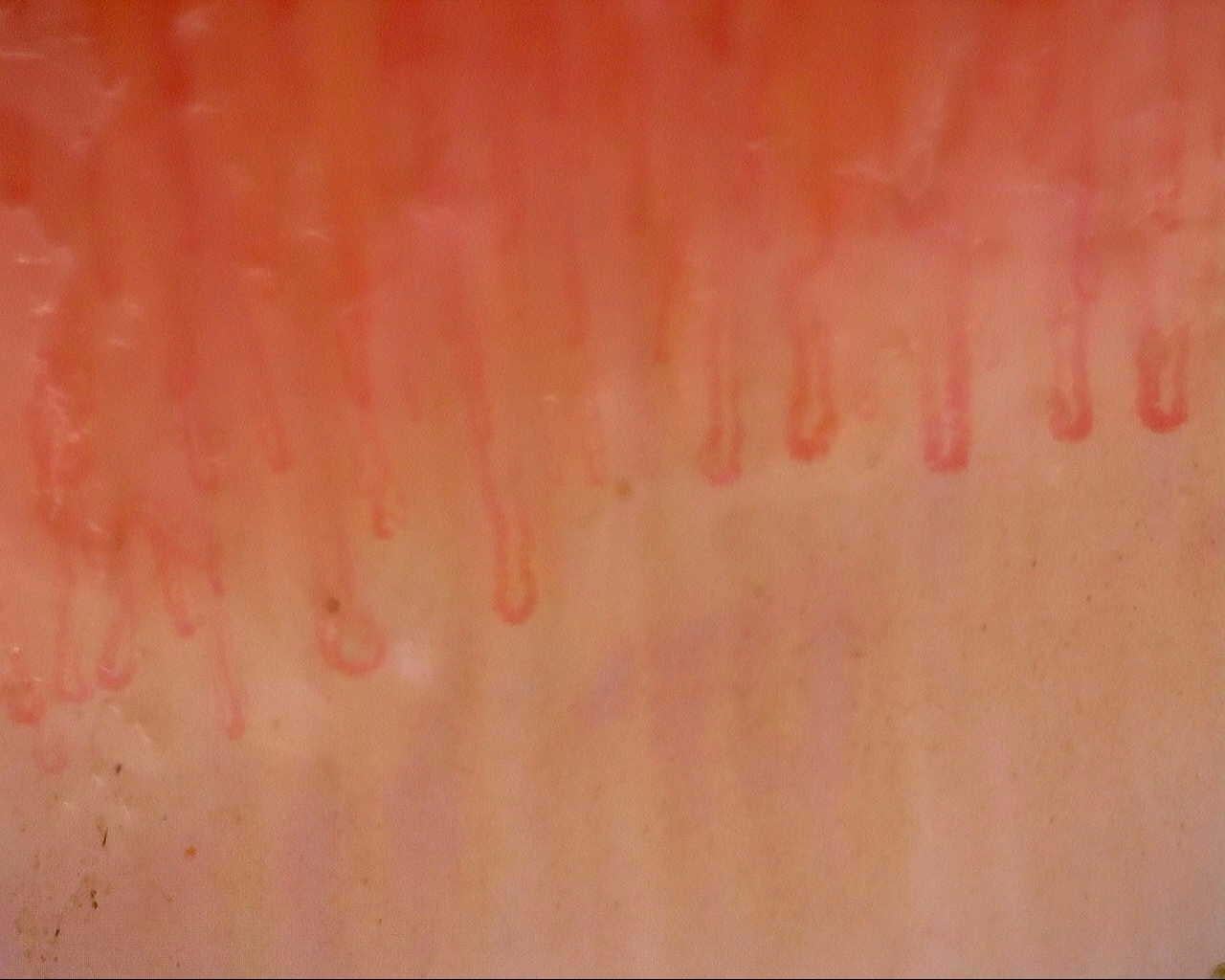 Nailfold capillaroscopy: left ring finger, field a. Follow-up study. Mixed Connective Tissue Disease Presenting with Raynaud Phenomenon.