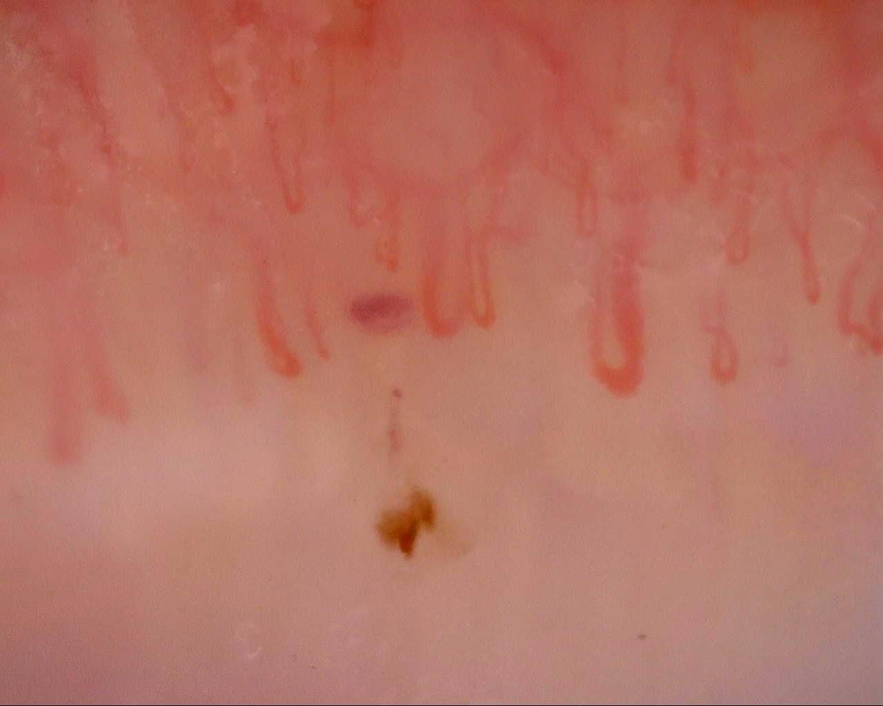 Nailfold capillaroscopy: left ring finger, field c. Initial study. Mixed Connective Tissue Disease Presenting with Raynaud Phenomenon.