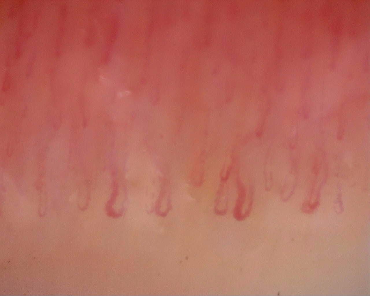 Nailfold capillaroscopy: right index finger, field a. Initial study. Mixed Connective Tissue Disease Presenting with Raynaud Phenomenon.