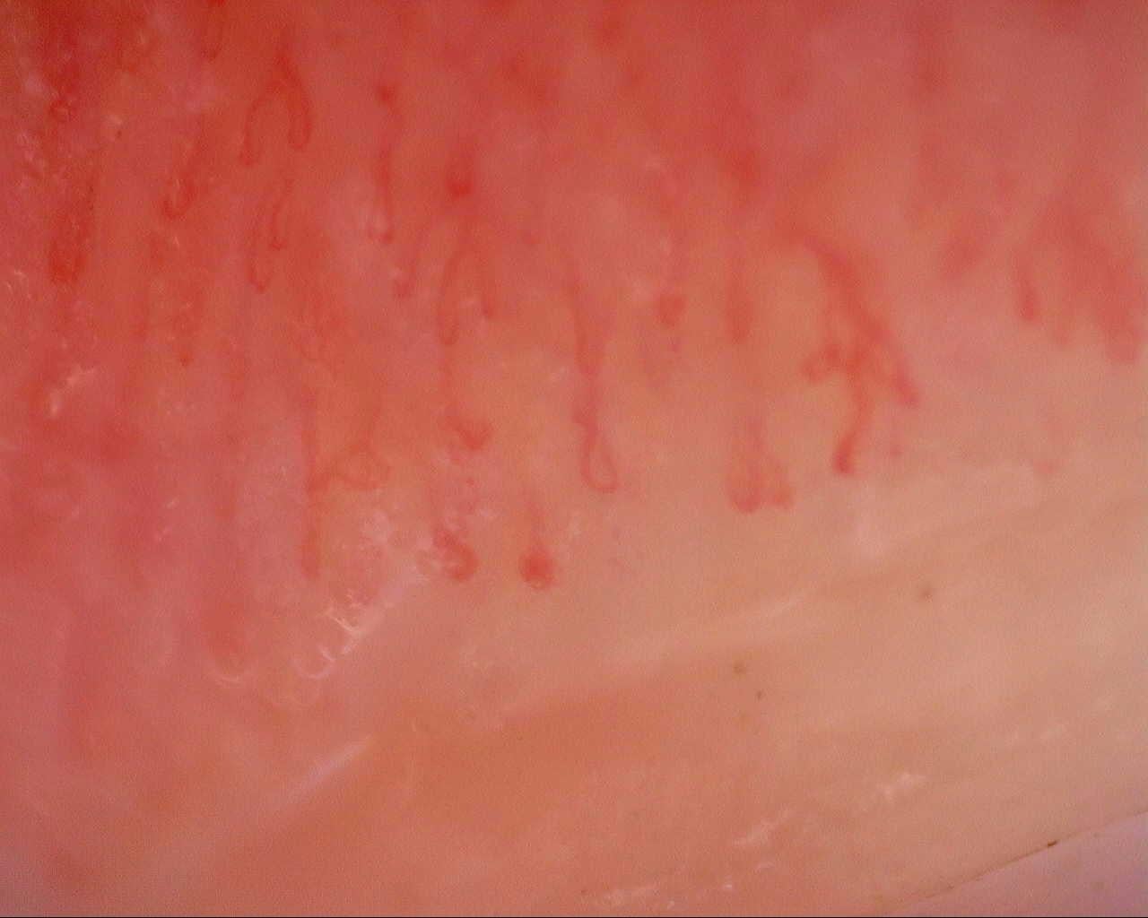Nailfold capillaroscopy: left index finger, field c. Initial study. Mixed Connective Tissue Disease Presenting with Raynaud Phenomenon.