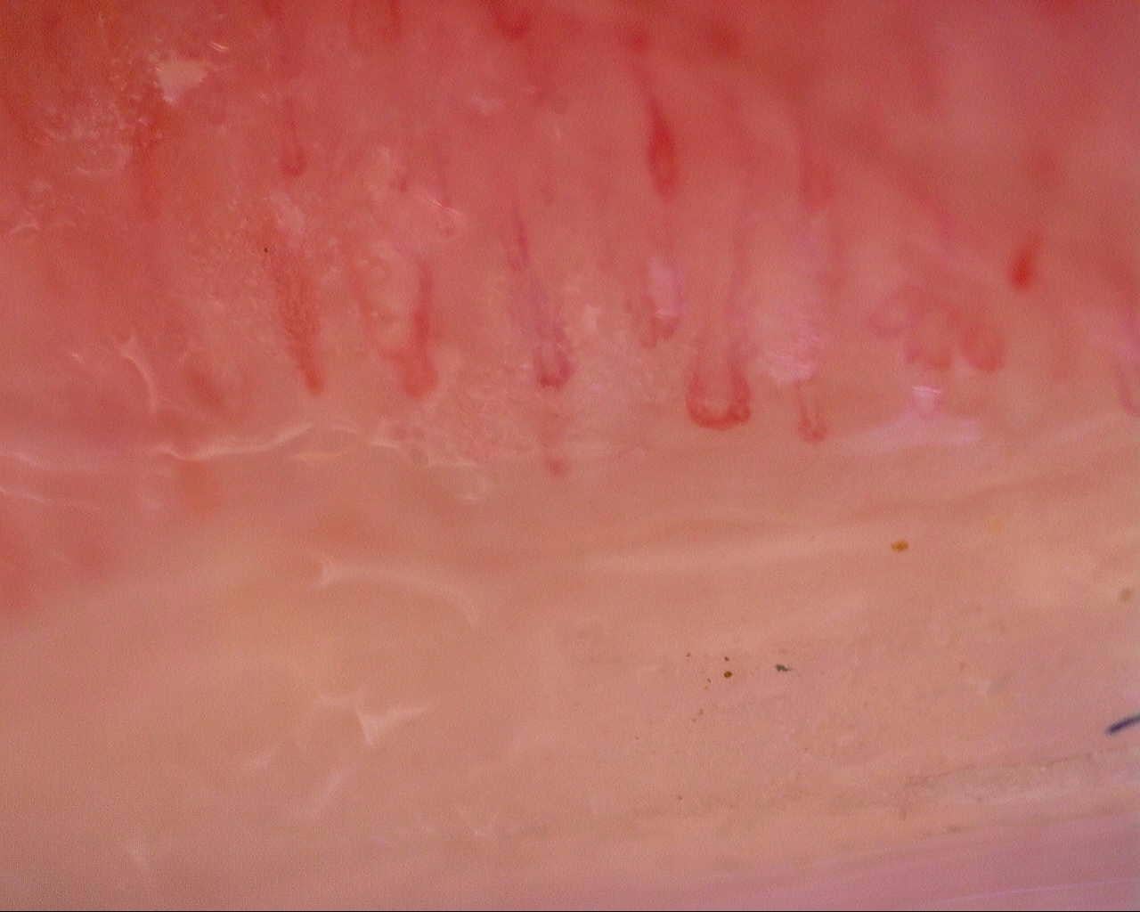 Nailfold capillaroscopy: left index finger, field b. Initial study. Mixed Connective Tissue Disease Presenting with Raynaud Phenomenon.