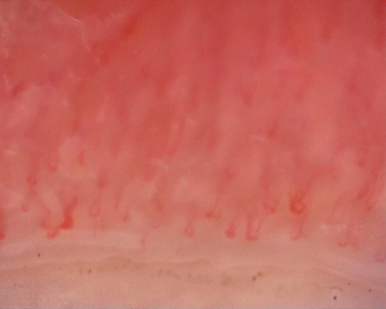 Nailfold capillaroscopy: right middle finger, field b. Initial study. Mixed Connective Tissue Disease Presenting with Raynaud Phenomenon.