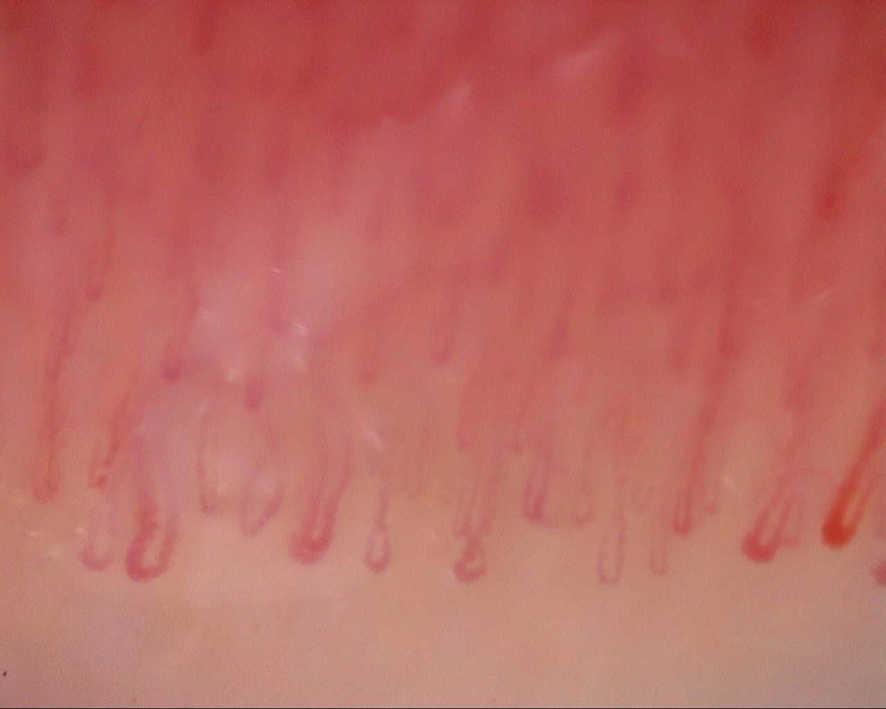 Nailfold capillaroscopy: right index finger, field b. Initial study. Mixed Connective Tissue Disease Presenting with Raynaud Phenomenon.